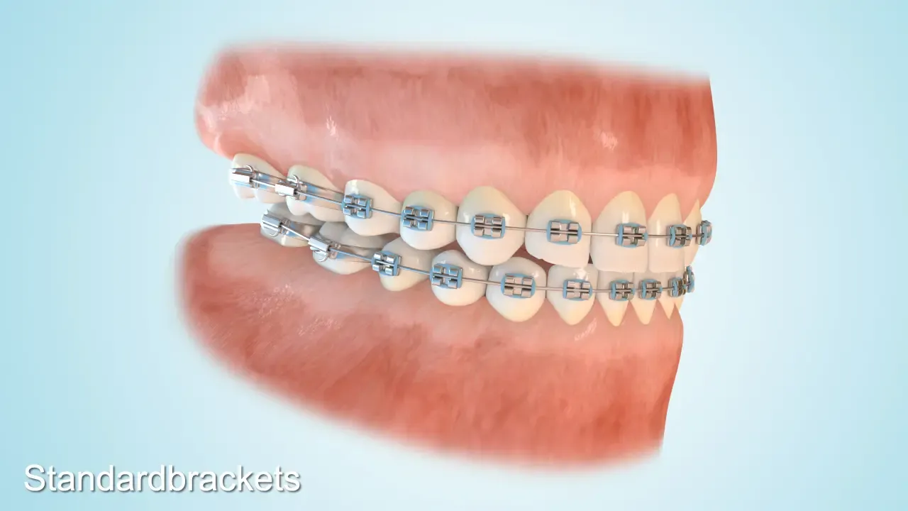 Eine 3D-Darstellung einer festen Zahnspange mit Metallbrackets. Klassische Metallbrackets sind eine effektive Lösung zur Korrektur von Zahnfehlstellungen bei Kindern und Jugendlichen.