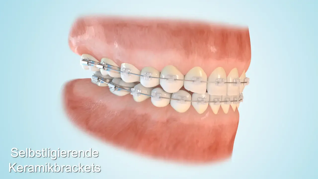Eine 3D-Darstellung einer festen Zahnspange mit Keramikbrackets. Keramikbrackets bieten eine dezente Alternative für Jugendliche, die eine unauffällige Zahnkorrektur wünschen.