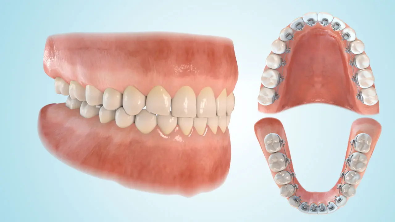 Eine 3D-Darstellung der Lingualtechnik, bei der die Zahnspange an der Innenseite der Zähne befestigt ist. Eine linguale Zahnspange ist eine nahezu unsichtbare Lösung für Jugendliche.