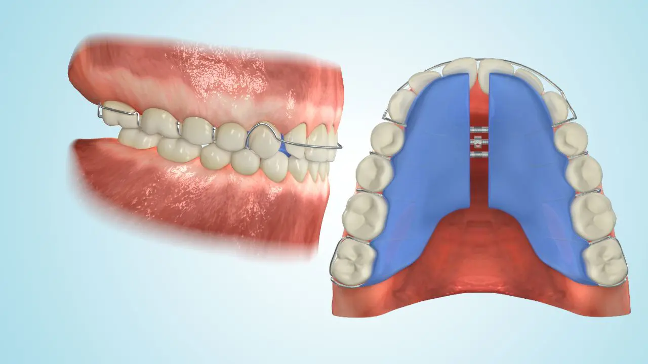Eine 3D-Darstellung einer herausnehmbaren Zahnspange. Herausnehmbare Zahnspangen sind eine flexible Option zur Zahnkorrektur bei Kindern.
