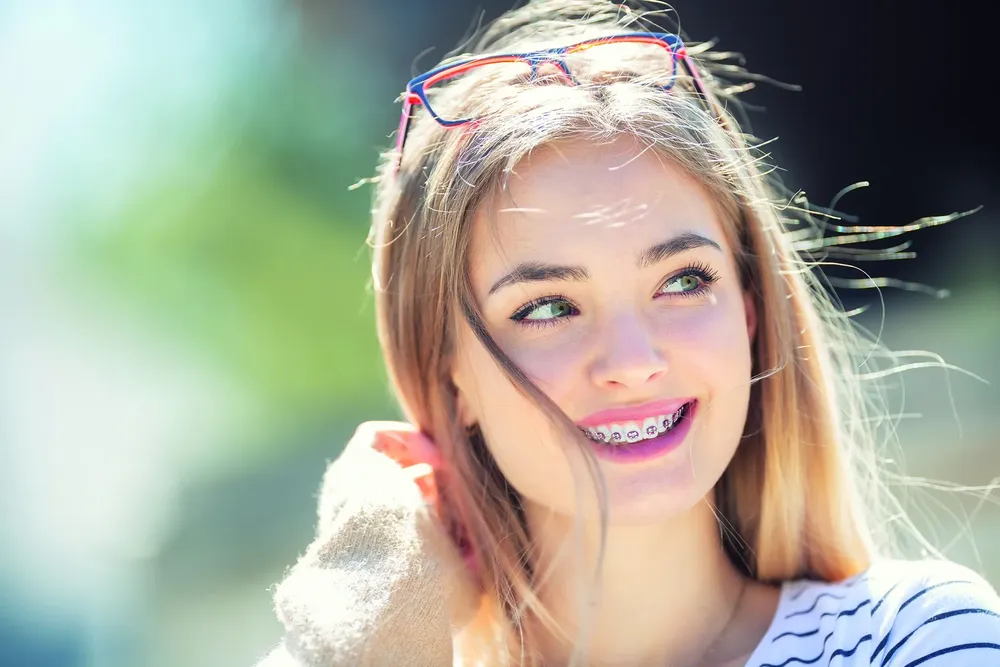 Festsitzende Zahnspangen Wien – Brackets für jedes Alter