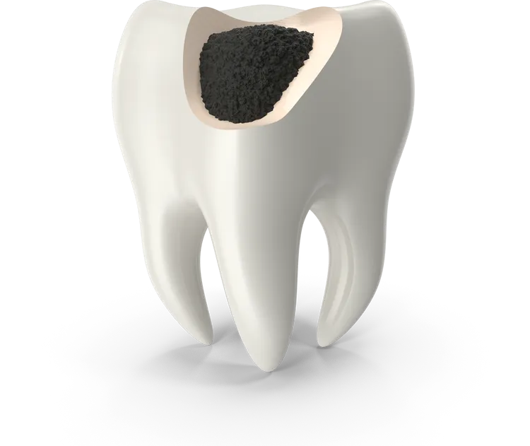 Karies im Zahninneren – moderne Behandlungsmethoden beim Zahnarzt in Wien